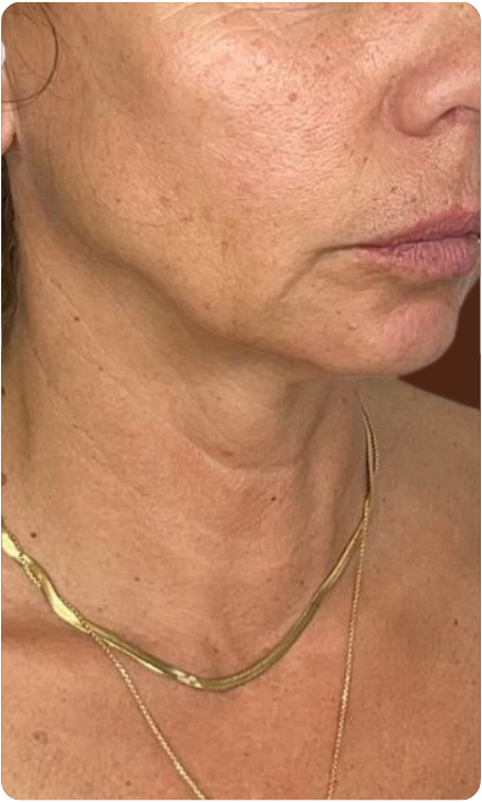 Avant traitement Sculptface