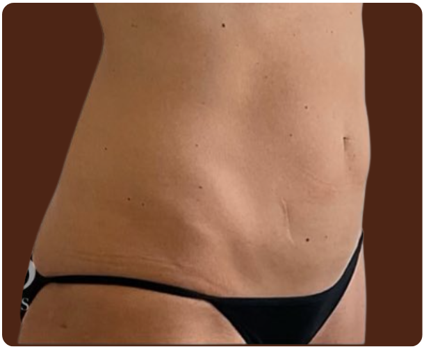 Après traitement Laser Diode