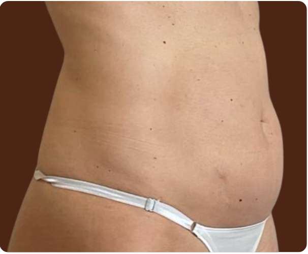 Avant traitement Laser Diode