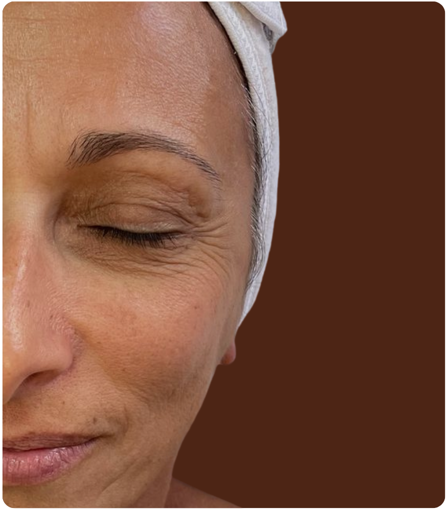 Avant traitement Sculptface