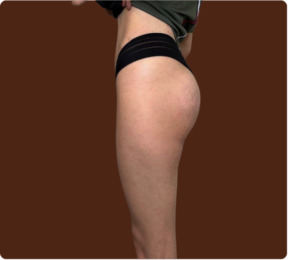 Après traitement Bodysculpt