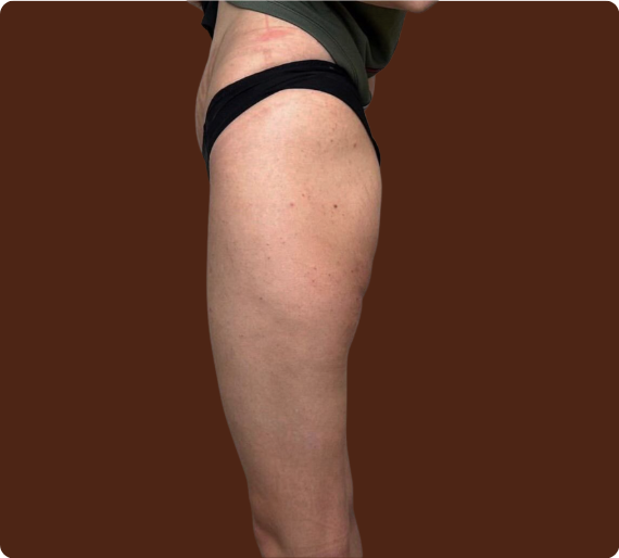 Avant traitement Bodysculpt