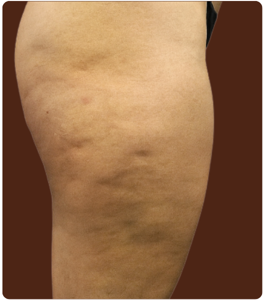 Avant traitement Cryolipolyse