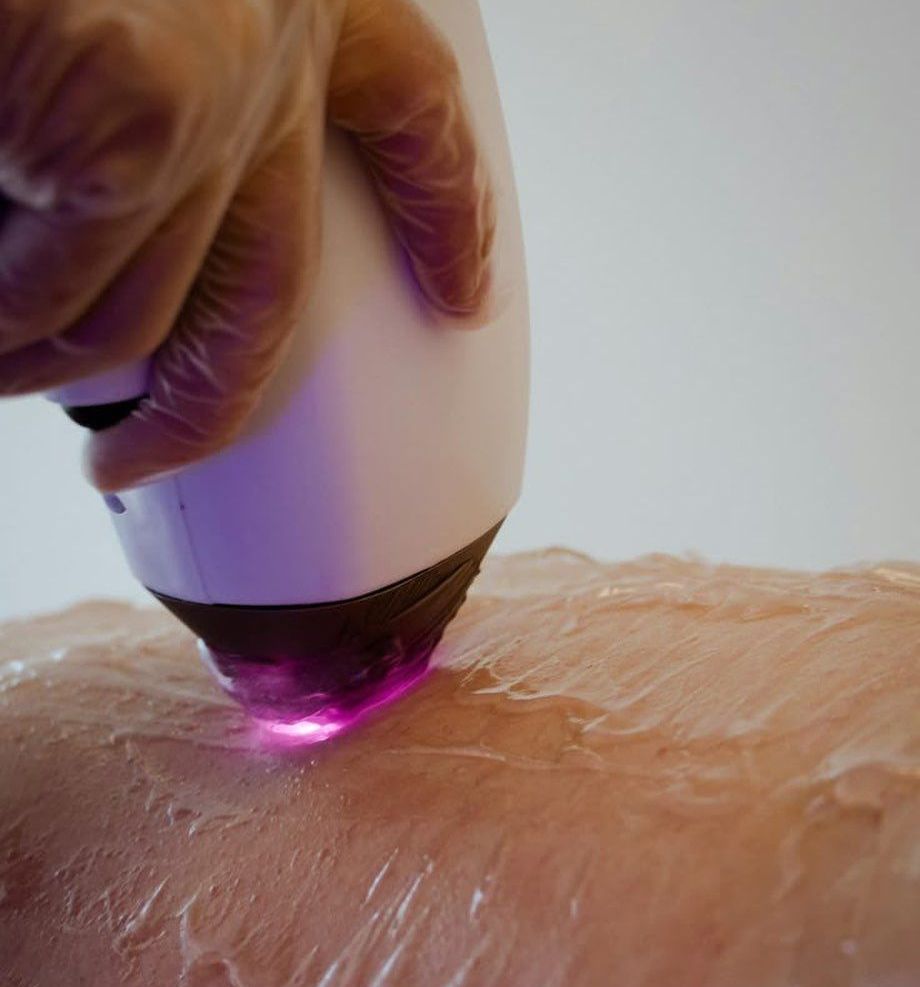 Laser épilation