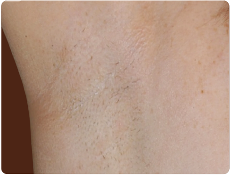 Après traitement Laser Diode