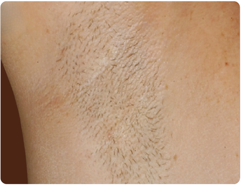 Avant traitement Laser Diode